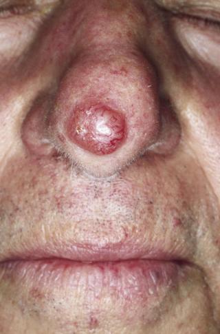 Basalioma of a spherical type. Reddish wax-like nodule on the tip of the nose. Telangiectasias are visible on the surface.